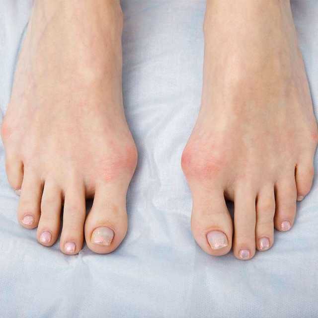 تورم إصبع القدم الكبير.. العرض البسيط الذي قد يكشف أمراضًا خطيرة