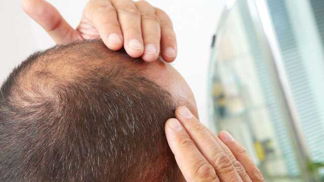 وداعا للصلع.. دراسة جديدة تكشف عن تقنية رهيبة لعلاج تساقط الشعر