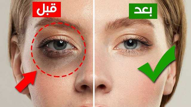 وصفة طبيعية معجزة للقضاء على الهالات السوداء بلمح البصر.. آمنة وفعالة 100%