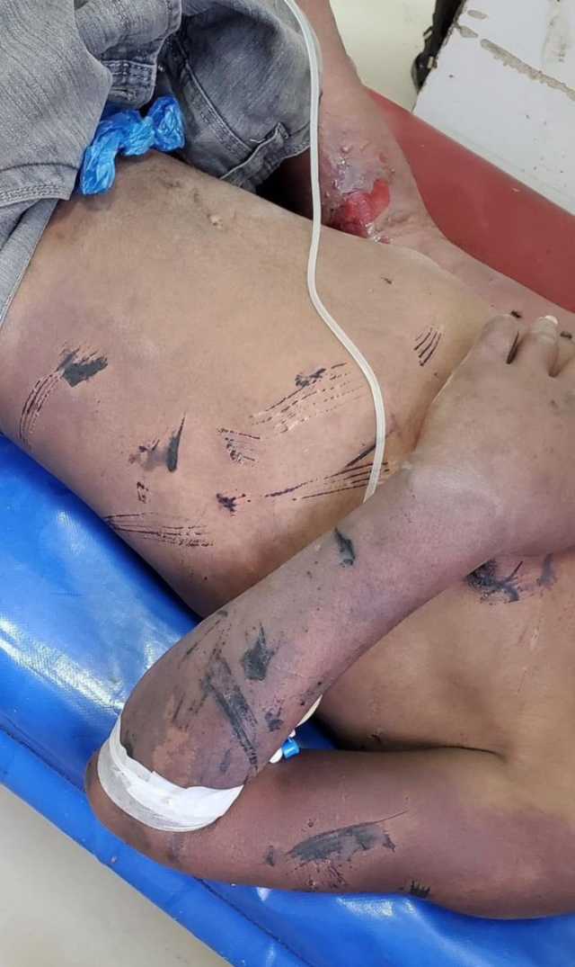 صورة لمأساة جديدة... وفاة أحد المخفين قسرا في سجون مليشيا الحوثي الإرهابية متأثرا بما تعرض له من تعذيب
