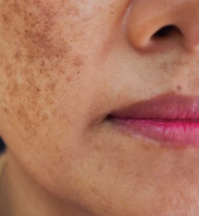 علامات تظهر على وجهك تدل على الإصابة بمرض السرطان