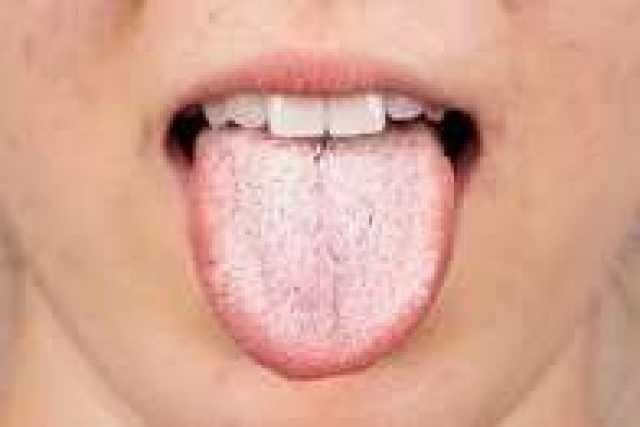 هل اللسان الأبيض علامة على مرض خطير ..تفاصيل