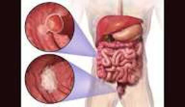 الكشف عن علاقة جرثومة المعدة والهلع والوسواس ..تفاصيل