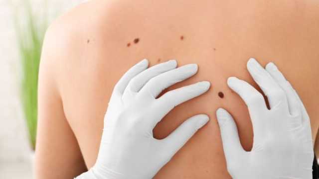 سرطان الجلد: أنواعه،أعراضه،طرق علاجه