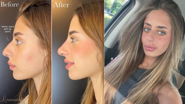 ميا شيم تعالج نفسيتها المحطمة بعد الأسر لدى حماس بـ عملية تجميل