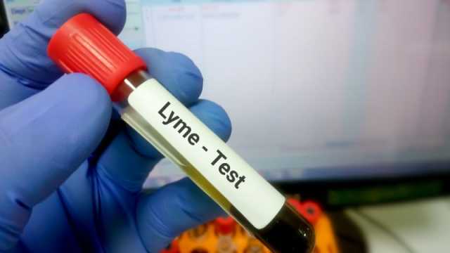 مرض لايم: الأسباب، الأعراض، طرق العلاج