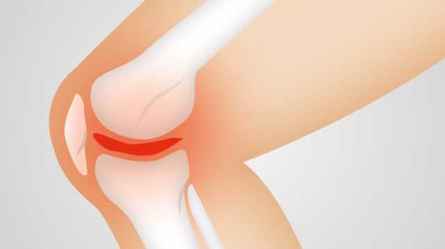 هذه أعراض ‫التهاب المفاصل الروماتويدي