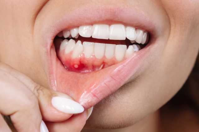 القرح الفموية المستمرة قد تُنذر بسرطان الفم