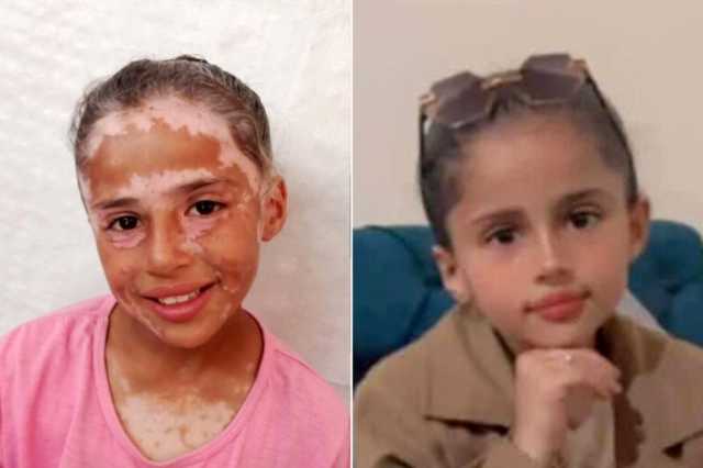 لانا الشريف وجه الطفولة بغزة الذي شوهته الحرب الإسرائيلية