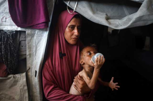 صورة طفل فلسطيني بوجه غائر وذراع هزيلة تشعل حملة تضليل رقمية عالمية