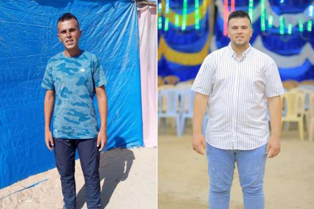ليست حمية ولا رياضة.. غزيون يوثقون أثر المجاعة على أجسادهم