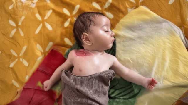 وزارة الصحة الفلسطينية: ستة آلاف ممن بترت أرجلهم أو أحد أطرافهم يحتاجون لبرامج تأهيل عاجلة