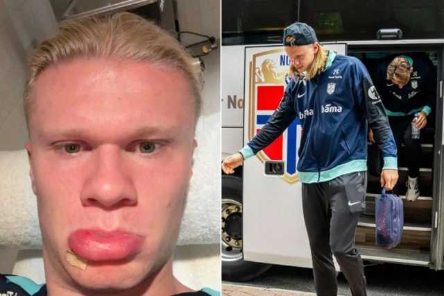 هالاند يتعرض لحادث غريب في وجهه