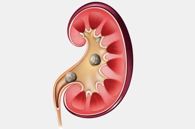 أمراض الكلى المزمنة أصبحت أزمة صحية عالمية وفقا لدراسة حديثة