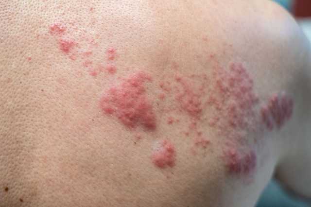 ‫التطعيم ضد الهربس النطاقي مهم لهؤلاء