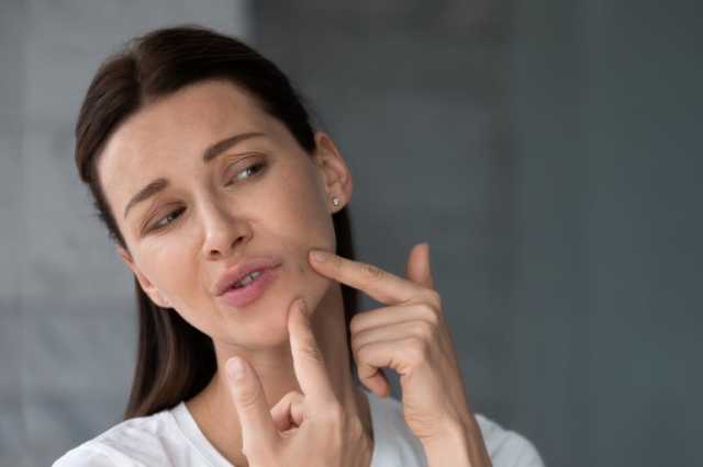 كيف تتخلصين من كابوس البثور العميقة في الوجه؟