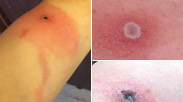في العالم.. تسجيل أول حالة وفاة بجدري ألاسكا