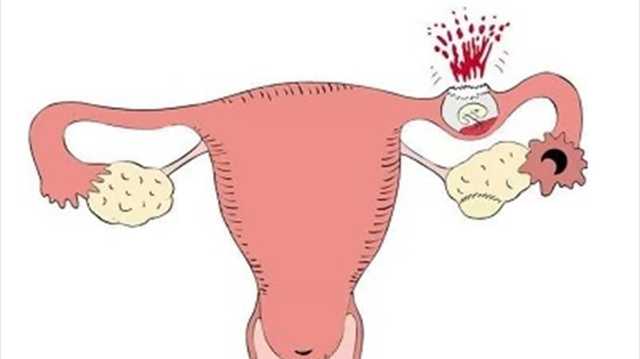 ما هو الحمل الهاجر.. وهل يمكن الوقاية منه؟