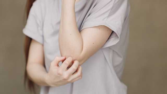 اخصائية تقدم نصائح لمن يعاني من حساسية الشمس