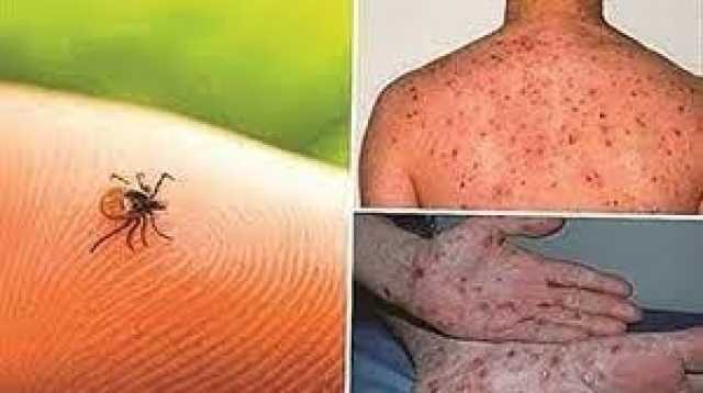 صحة نينوى تسجل إصابة بالحمى النزفية لطفل بعمر 13 عامًا