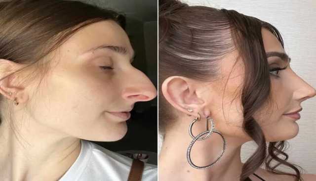 جراحة تجميل بـ11 ألف دولار ساعدت امرأة على إنهاء زواجها.. كيف؟