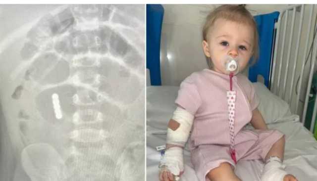 مأساة.. طفلة تفقد جزءاً من أمعائها بسبب مغناطيس لعبة