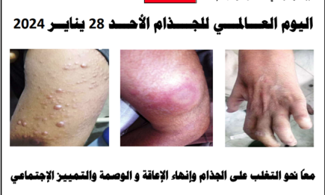 شفاء أكثر من 14 ألف حالة جذام في اليمن