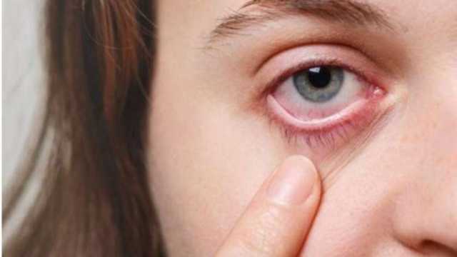4 أسباب وراء الإصابة بحساسية العين.. اتبع هذه النصائح لتجنبها في الصيف