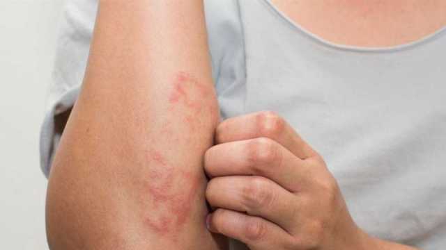 تزداد أعراضه في الشتاء.. 7 نصائح للوقاية من التهابات الإكزيما