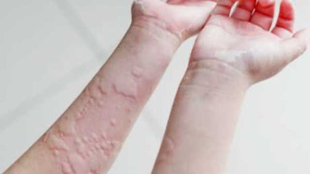 تحذير من انتشار حساسية عثة الغبار في الشتاء.. ما الأعراض وطرق العلاج؟