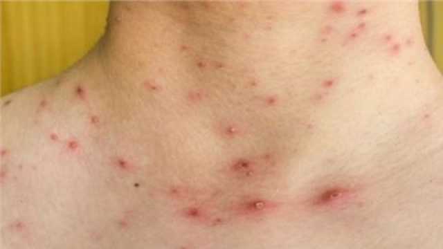 أعراض فيروس جدري ألاسكا بعد تسببه في وفاة مواطن أمريكي.. احذر «خربشة القطة»
