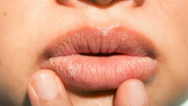 5 نصائح لعلاج اسمرار الشفاه.. توقفي عن هذه العادات الخاطئة