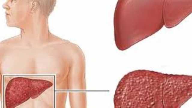 علامة غير شائعة تدل على الإصابة بالكبد.. اذهب إلى الطبيب فورا