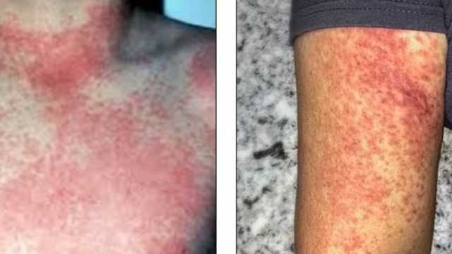 انتشار عدوى خطيرة في أمريكا تنتقل عن طريق البعوض.. تعرف على أعراضها