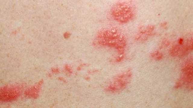 4 أعرض تدل على الإصابة بفيروس الحزام الناري.. تعرف عليها
