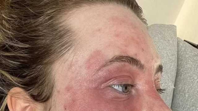 سيدة تناولت علاج للأسنان أدى إلى إصابتها بداء الفيل.. ما القصة؟