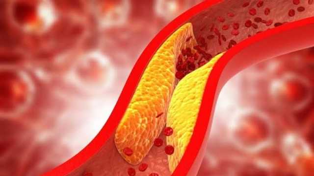 صحة الشرقية تكشف أعراض الكوليسترول.. أطعمة تخفف من حدة المرض