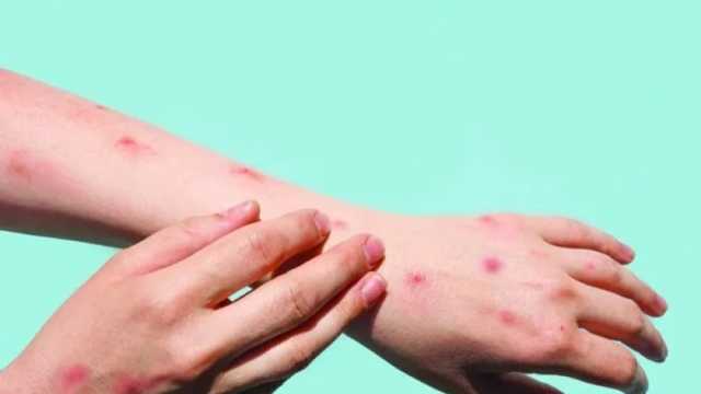 «الصحة العالمية» تدعو لتعزيز المراقبة وتبادل البيانات حول جدري القرود بين الدول