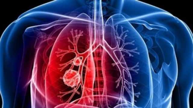 علامة شائعة تدل على الإصابة بسرطان الرئة.. إذا استمرت أسبوعين اذهب للطبيب فورا