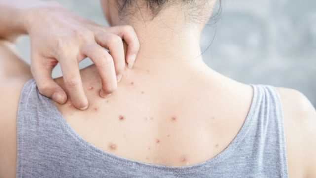 5 أسباب لمشكلة حبوب الظهر في الصيف.. اتبع هذه النصائح لعلاجها
