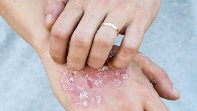 أسباب الصدفية وعلاجها.. مرض يستمر مدى الحياة في حالة واحدة