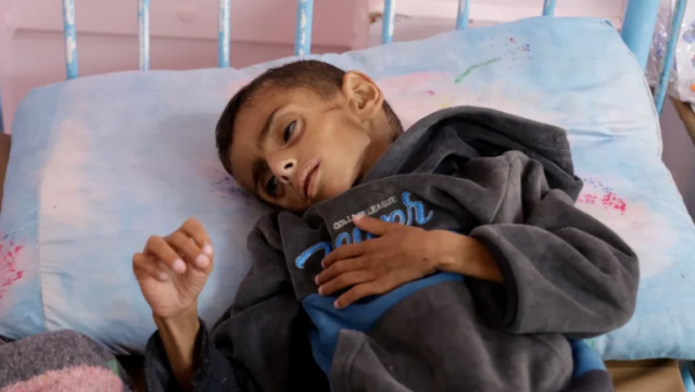 منهم 89 طفلاً.. ارتفاع عدد وفيات المجاعة في قطاع غزة إلى 154 حالة