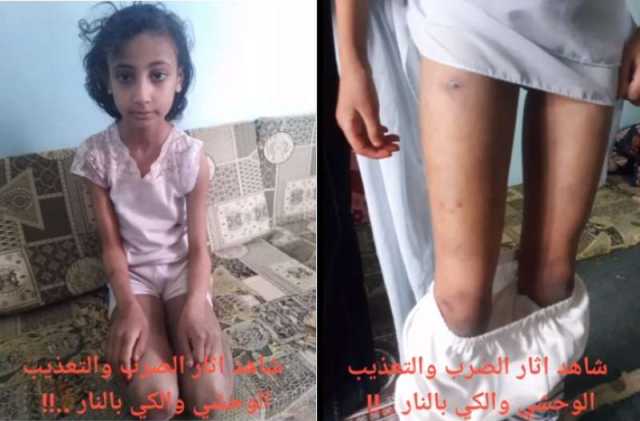 جريمة تهز اليمن .. تناوب على اغتصاب طفلة يتيمة من قبل ”أعمامها” وتعذيب إخوتها القاصرين بالنار في صنعاء ”فيديو”