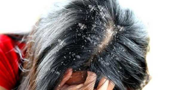 كيف تحمي شعرك من القشرة في فصل الشتاء؟