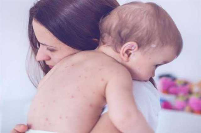 ارتفاع عدد الإصابات بالحصبة في بريطانيا