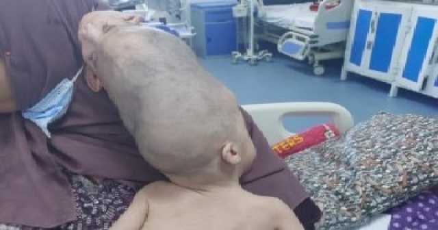 نجاح أول عملية فصل توأم ملتصق بالرأس في الإسكندرية