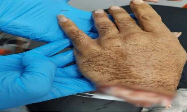 انقاذ يد مبتورة.. انجاز طبي في محافظة السويس