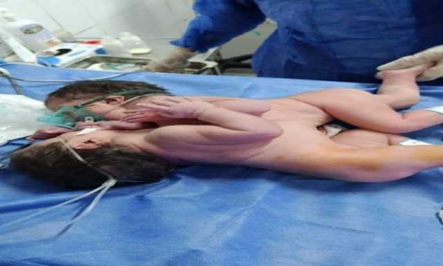 ولادة نادرة لتوأم ملتصق بمستشفى الفيوم العام