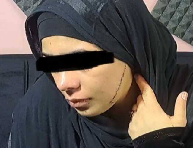 قبل أيام من زفافها.. فتاة تتعرض لتشويه وجهها بـ «41 غرزة» على يد طليقة العريس