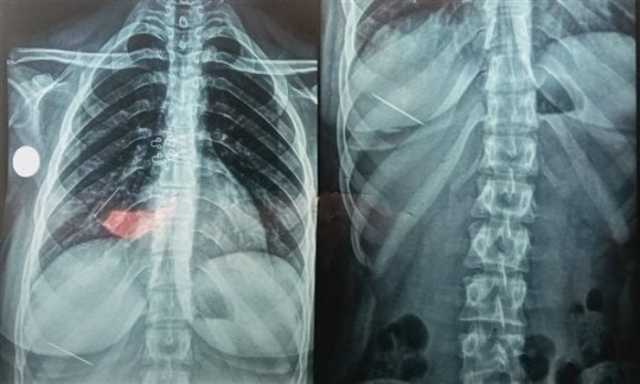 بلعت دبوس.. إنقاذ فتاة من اختناق حاد في مستشفيات جامعة المنوفية